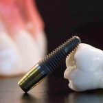 Имплантация зубов: инновационное решение для здоровой улыбки и самоуверенности