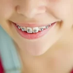 Больно ли ставить брекеты? Ощущения во время процедуры